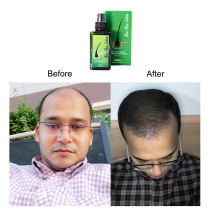 Neo Hair Lotion Original from Thailand 120ml with Derma Roller