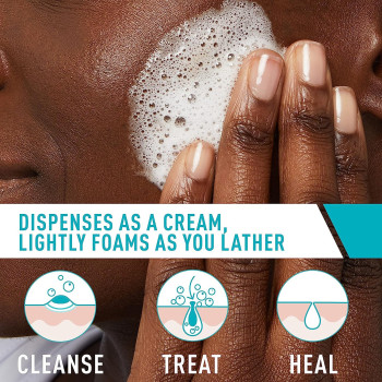 CeraVe Acne Foaming Cream Cleanser, 5 Fl Oz (Pack of 1)