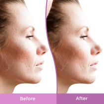 Acne Scar Spot Treatment for Face, Resurfacing Scar Gel, 1 Oz (30 ML)