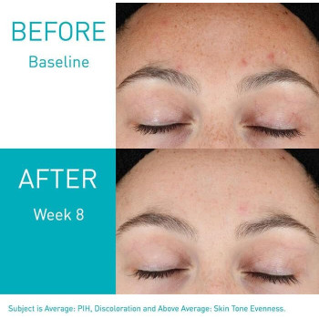 CeraVe Resurfacing Retinol Serum For Post-Acne Marks, Pores And Skin Texture, Brightening Facial Serum With Retinol And Niacinamide - 1 Fl Oz (30 ML)