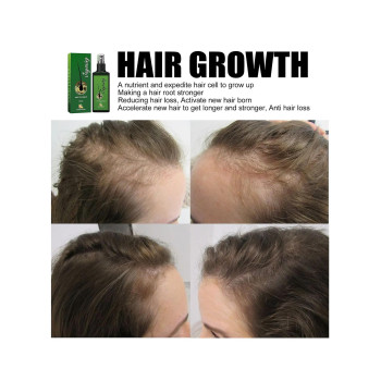 Jaysuing Hair Growth Lotion and Hair Oil For Hair Loss, Repair Damaged Hair, Nourishing Hair Roots & Prevent Baldness - 30 ml