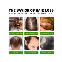 Jaysuing Hair Growth Lotion and Hair Oil For Hair Loss, Repair Damaged Hair, Nourishing Hair Roots & Prevent Baldness - 30 ml