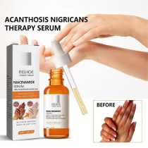 Eelhoe Niacinamide Serum Brighten Dark Knuckles Hands, Knees, Elbows, Armpit Intense Stains Remover Whitening Serum - 30ml