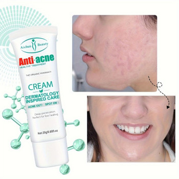 Aichun Beauty Anti Acne Face Cream For Acne And Blemish, Acne Spot and Acne Scars Treatment 20g