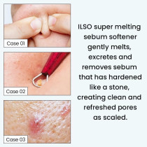ilso Super Melting Sebum Softener, 150Ml