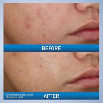 CeraVe Foaming Acne Face and Body Wash with Benzoyl Peroxide, Hyaluronic Acid, and Niacinamide - 5oz