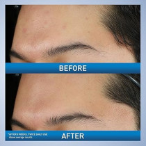 CeraVe Foaming Acne Face and Body Wash with Benzoyl Peroxide, Hyaluronic Acid, and Niacinamide - 5oz