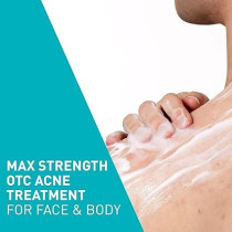 CeraVe Foaming Acne Face and Body Wash with Benzoyl Peroxide, Hyaluronic Acid, and Niacinamide - 5oz