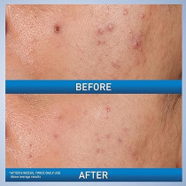 Cerave Salicylic Acid Acne Treatment with Glycolic Acid and Lactic Acid AHA/BHA Acne Gel for Face to Control and Clear Breakouts