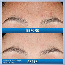 CeraVe Retinol Serum for Post-Acne Marks and Skin Texture Pore Refining, Resurfacing, Brightening Facial Serum with Retinol and Niacinamide Fragrance Free, Paraben Free And Non-Comedogenic 1 Oz
