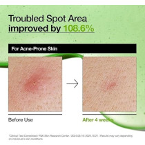 Anua Azelaic Acid 10 Hyaluron Redness Soothing Serum, Facial Serum For Sensitive Skin, Hyaluronic Acid, Niacinamide, Spot Care, Natural Color, Vegan, Korean Skincare, 30Ml