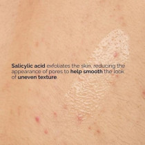 The Ordinary Salicylic Acid 0.5Percentage Body Serum (240Ml) – Exfoliating Treatment For Softening Rough, Bumpy Skin And Refining Texture From Neck To Toe