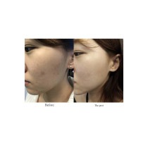 Axis-Y Niacinamide Serum For Skin, Dark Spot Correcting, Anti Blemish, Brightening, Glow Serum 50Ml